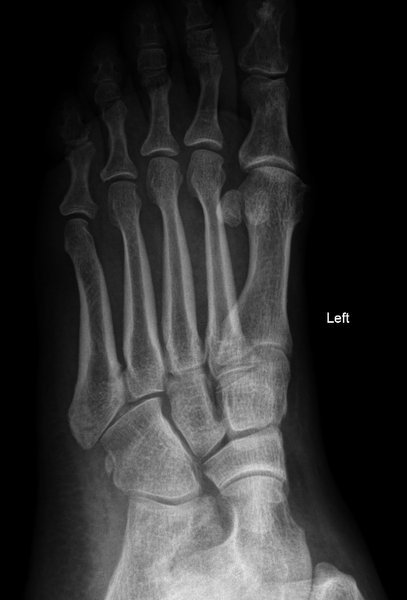 File:Avulsion fracture of the 5th metatarsal styloid - pseudo-Jones fracture (Radiopaedia 62857-71228 Oblique 1).PNG