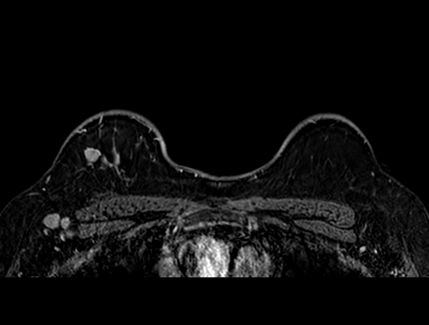 Axillary lymph nodes - surgical levels (Radiopaedia 84413-104719 Axial T1 C+ fat sat 24).jpg