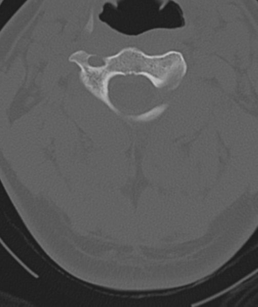 File:Axis peg fracture (type 3) and atlas lateral mass (type 4) fracture (Radiopaedia 37474-39324 Axial bone window 19).png