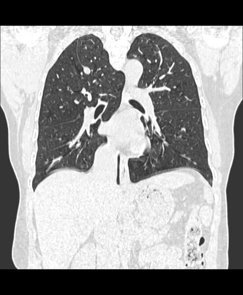 File:Azygos fissure and azygos lobe (Radiopaedia 41841-44832 Coronal lung window 10).jpg