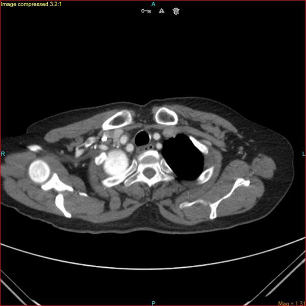 File:Azygos vein aneurysm (Radiopaedia 77824-90130 B 10).jpg