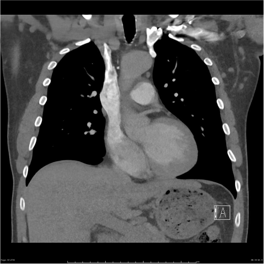 Azygos venous system anatomy (CT pulmonary angiography) (Radiopaedia 25928-26077 Coronal C+ CTPA 32).jpg
