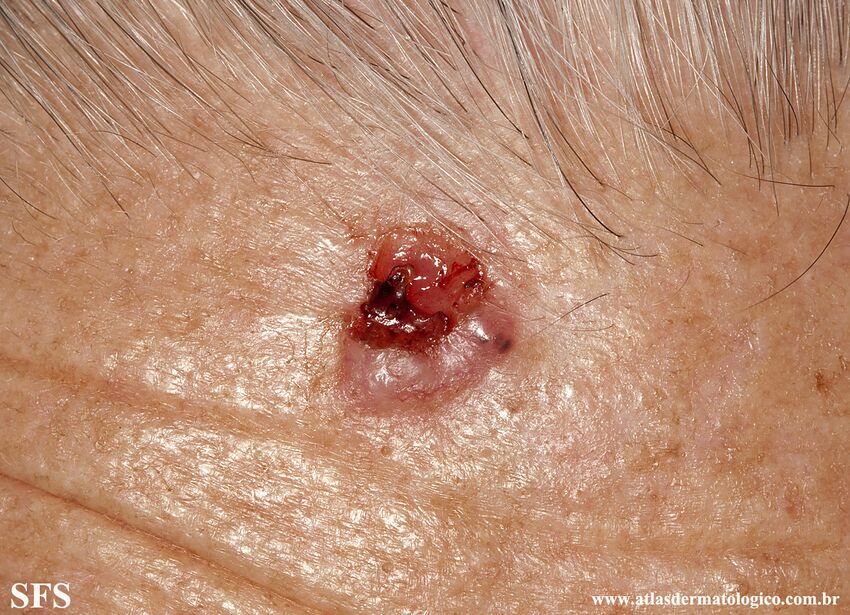 Basal Cell Carcinoma (Dermatology Atlas 293).jpg