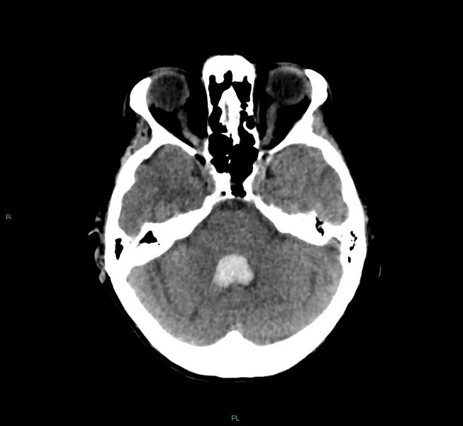File:Basal ganglia hemorrhage (Radiopaedia 58766-65988 Axial non-contrast 41).jpg