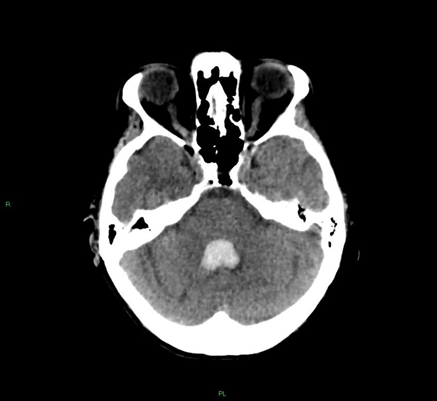 Basal ganglia hemorrhage (Radiopaedia 58766-65988 Axial non-contrast 41).jpg