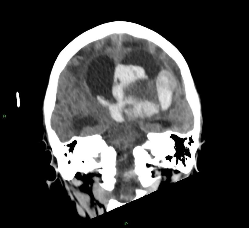 Basal ganglia hemorrhage (Radiopaedia 58766-65988 Coronal non-contrast 35).jpg