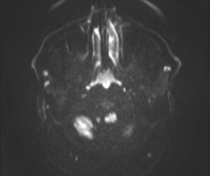 File:Basilar artery dissection (Radiopaedia 77032-88976 Axial DWI 22).jpg