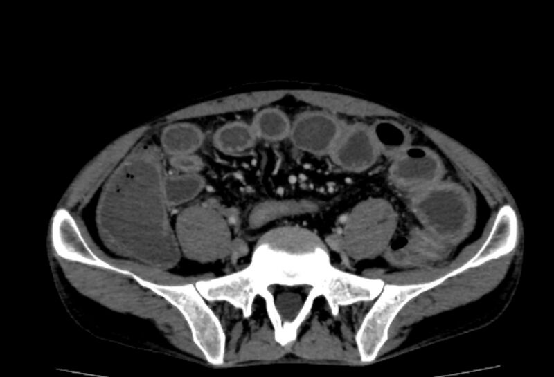 File:Behçet's disease- abdominal vasculitis (Radiopaedia 55955-62570 A 62).jpg