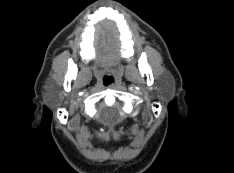 File:Benign mixed salivary tumor of the parotid gland (Radiopaedia 35261-36792 A 16).jpg
