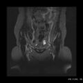 Bicornuate uterus- on MRI (Radiopaedia 49206-54297 Coronal STIR 2).jpg