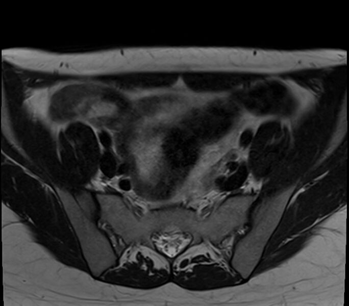 File:Bicornuate uterus (Radiopaedia 71214-81511 Axial T2 27).jpg