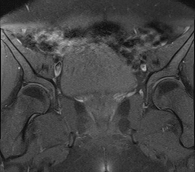 File:Bicornuate uterus (Radiopaedia 71214-81511 Coronal T1 fat sat 23).jpg
