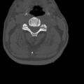 Bilateral C6-7 locked facet dislocation (Radiopaedia 28506-28748 Axial bone window 3).jpeg