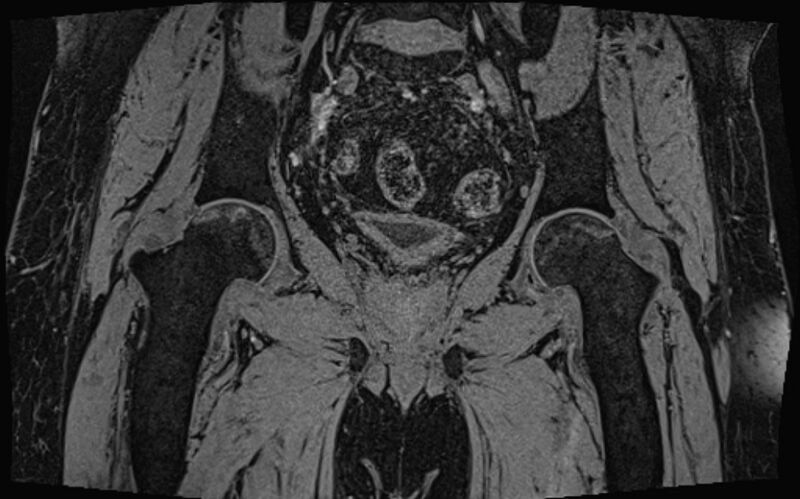 File:Bilateral avascular necrosis of femoral head (Radiopaedia 77116-89078 Coronal T2 we 33).jpg