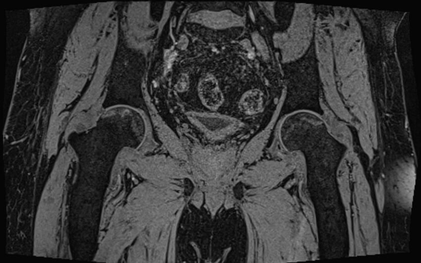 Bilateral avascular necrosis of femoral head (Radiopaedia 77116-89078 Coronal T2 we 33).jpg