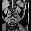 Bilateral conjoined nerve roots at different levels (Radiopaedia 73312-84063 B 38).jpg