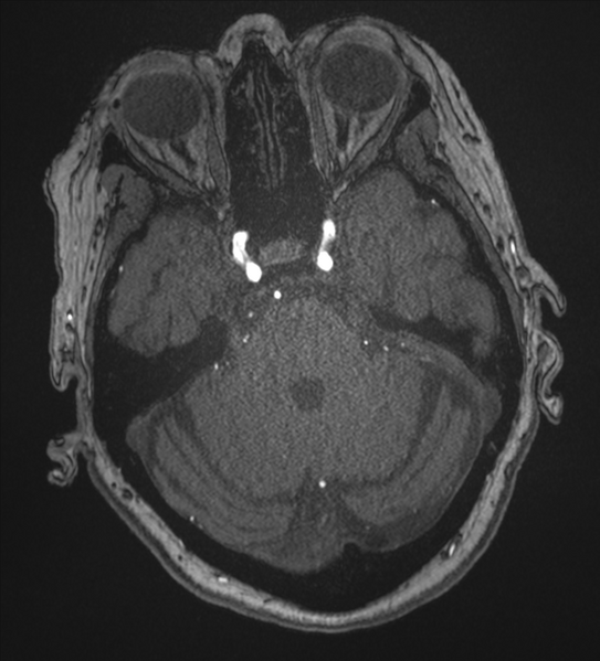 File:Bilateral fetal posterior communicating arteries (Radiopaedia 41286-44102 Axial MRA 55).png