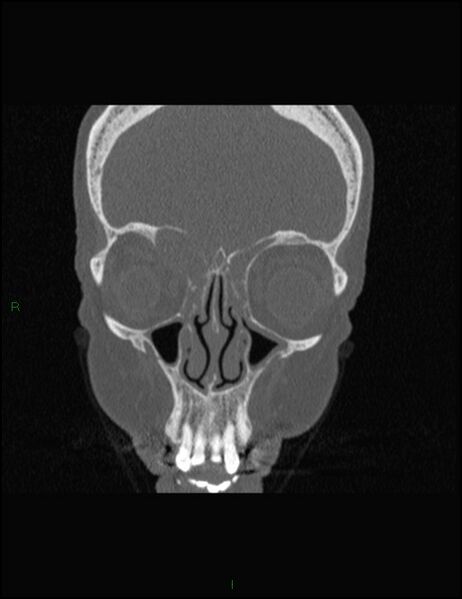 File:Bilateral frontal mucoceles (Radiopaedia 82352-96454 Coronal 108).jpg