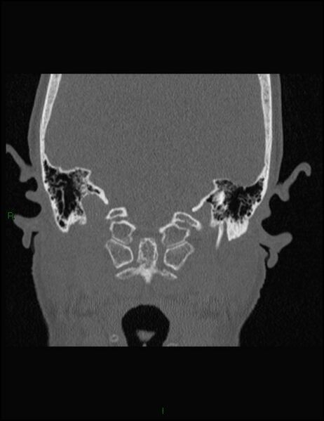 File:Bilateral frontal mucoceles (Radiopaedia 82352-96454 Coronal 329).jpg
