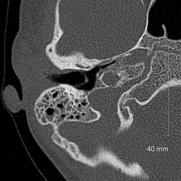 File:Bilateral grommets (Radiopaedia 47710-52404 Axial bone window 26).jpg