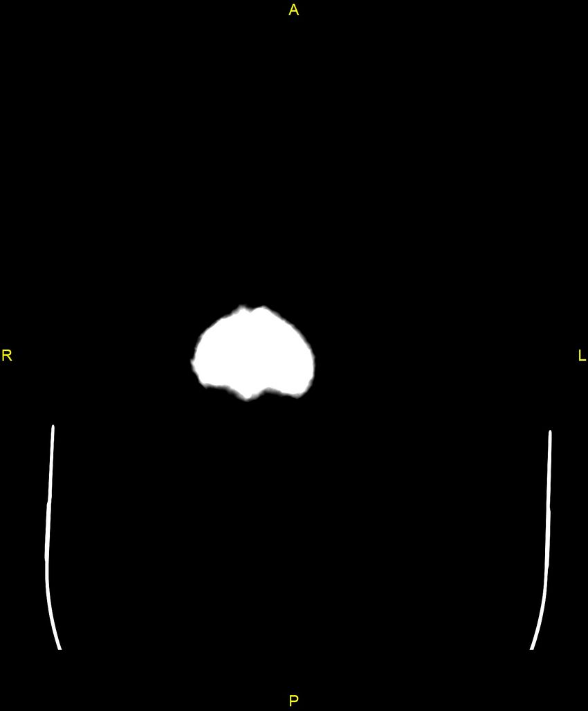 Bilateral isodense subdural hematomas (Radiopaedia 88621-105325 Axial non-contrast 114).jpg