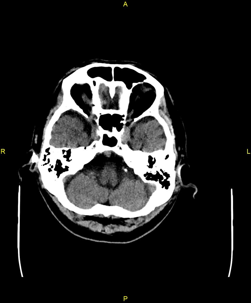 Bilateral isodense subdural hematomas (Radiopaedia 88621-105325 Axial non-contrast 20).jpg