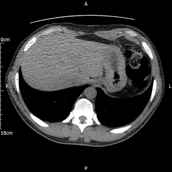 File:Bilateral medullary nephrocalcinosis with ureteric calculi (Radiopaedia 71269-81569 Axial non-contrast 7).jpg
