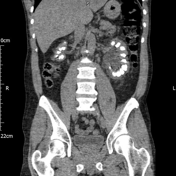 File:Bilateral medullary nephrocalcinosis with ureteric calculi (Radiopaedia 71269-81569 Coronal non-contrast 38).jpg