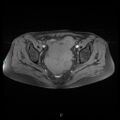 Bilateral ovarian fibroma (Radiopaedia 44568-48293 Axial T1 fat sat 16).jpg