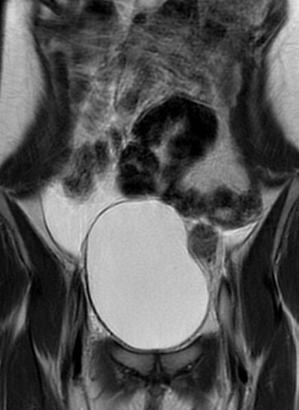 File:Bilateral ovarian fibrothecomas - adolescent (Radiopaedia 86604-102707 Coronal T2 10).jpg