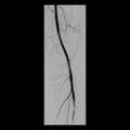 Bilateral popliteal artery entrapment (dynamic angiogram) (Radiopaedia 9420-10104 B 1).jpg