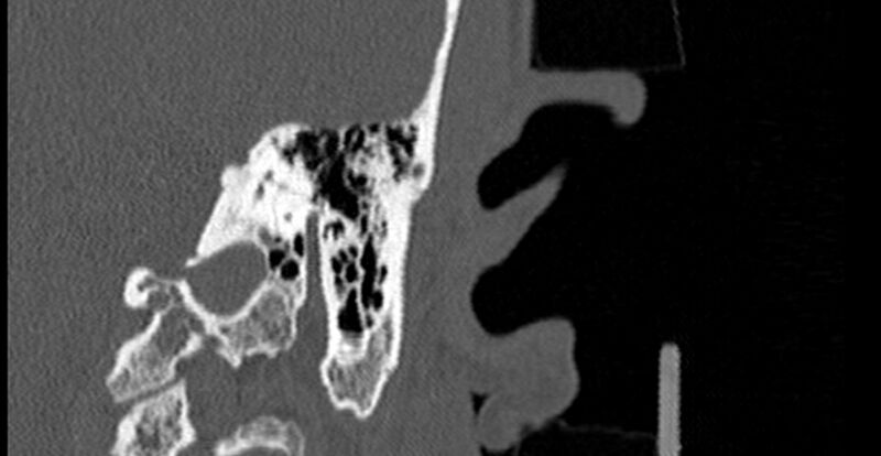 File:Bilateral temporal bone fractures (Radiopaedia 29482-29970 B 59).jpg
