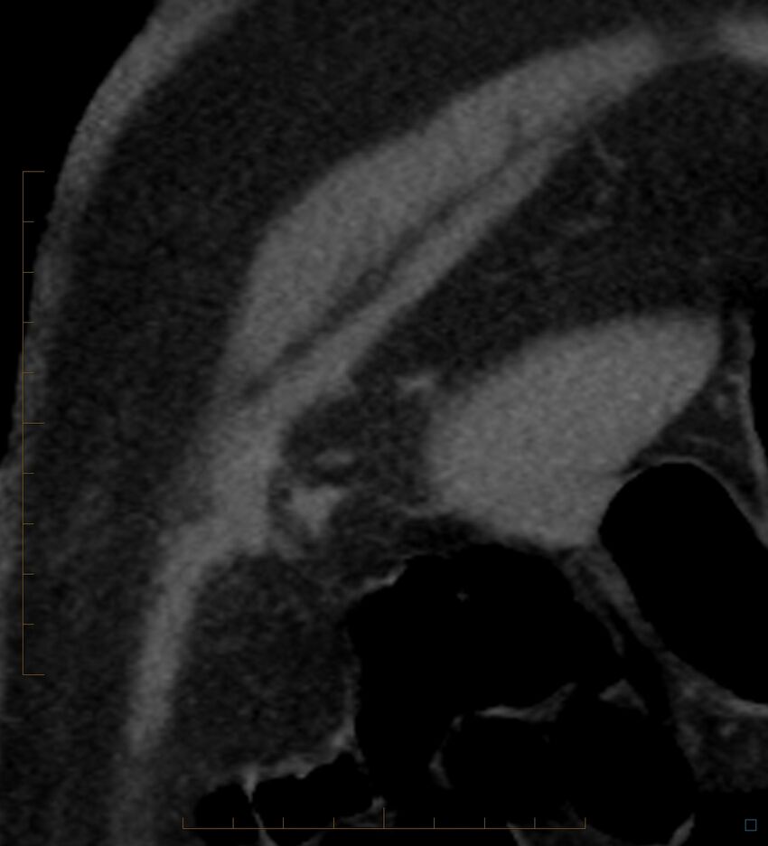 Bile leak from accessory duct(s) of Luschka post cholecystectomy (Radiopaedia 40736-43389 B 3).jpg