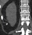Bile leak from accessory duct(s) of Luschka post cholecystectomy (Radiopaedia 40736-43389 B 60).jpg