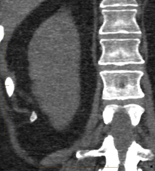 File:Bile leak from accessory duct(s) of Luschka post cholecystectomy (Radiopaedia 40736-43389 B 60).jpg