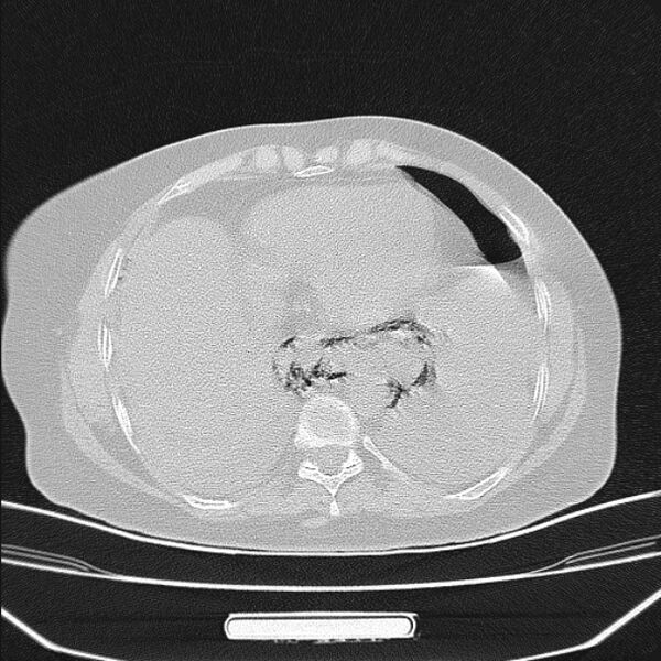 File:Boerhaave syndrome (Radiopaedia 45644-49799 Axial lung window 84).jpg