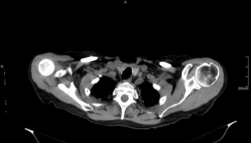 File:Brachial artery foreign body (Radiopaedia 54583-60820 Axial non-contrast 11).jpg