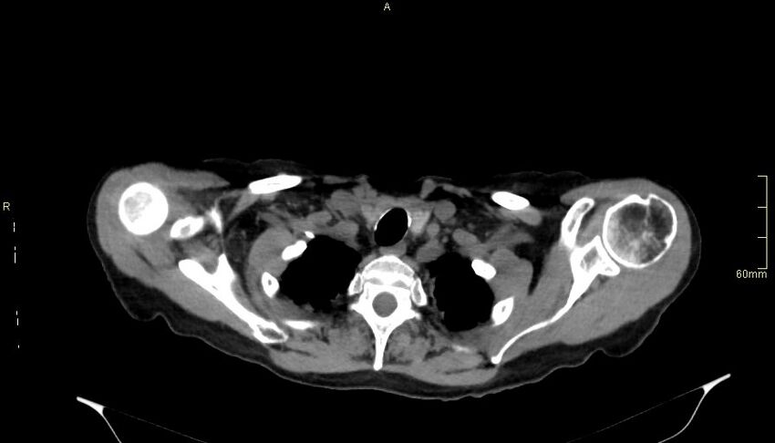 Brachial artery foreign body (Radiopaedia 54583-60820 Axial non-contrast 11).jpg