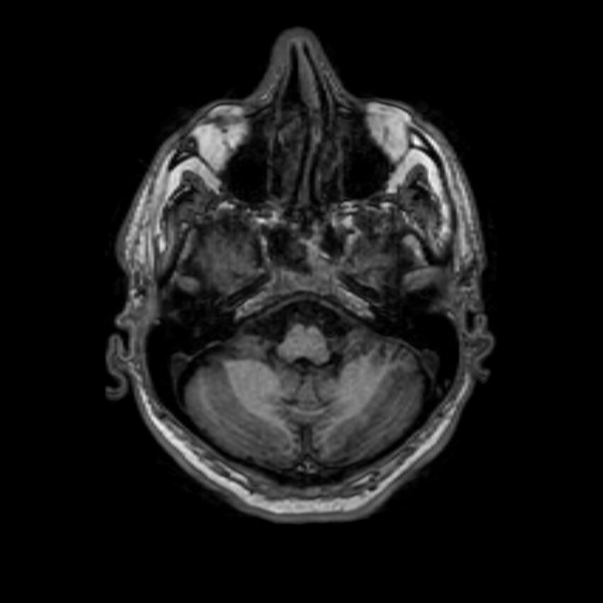 Brain abscess complicated by intraventricular rupture and ventriculitis (Radiopaedia 82434-96577 Axial T1 10).jpg