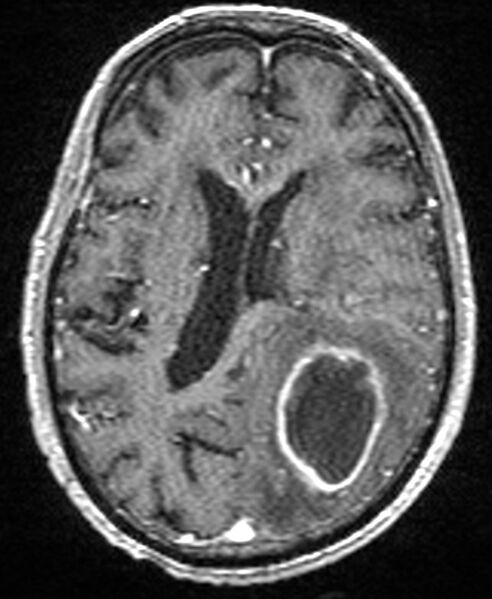 File:Brain abscess with dual rim sign (Radiopaedia 87566-103938 Axial T1 C+ 99).jpg