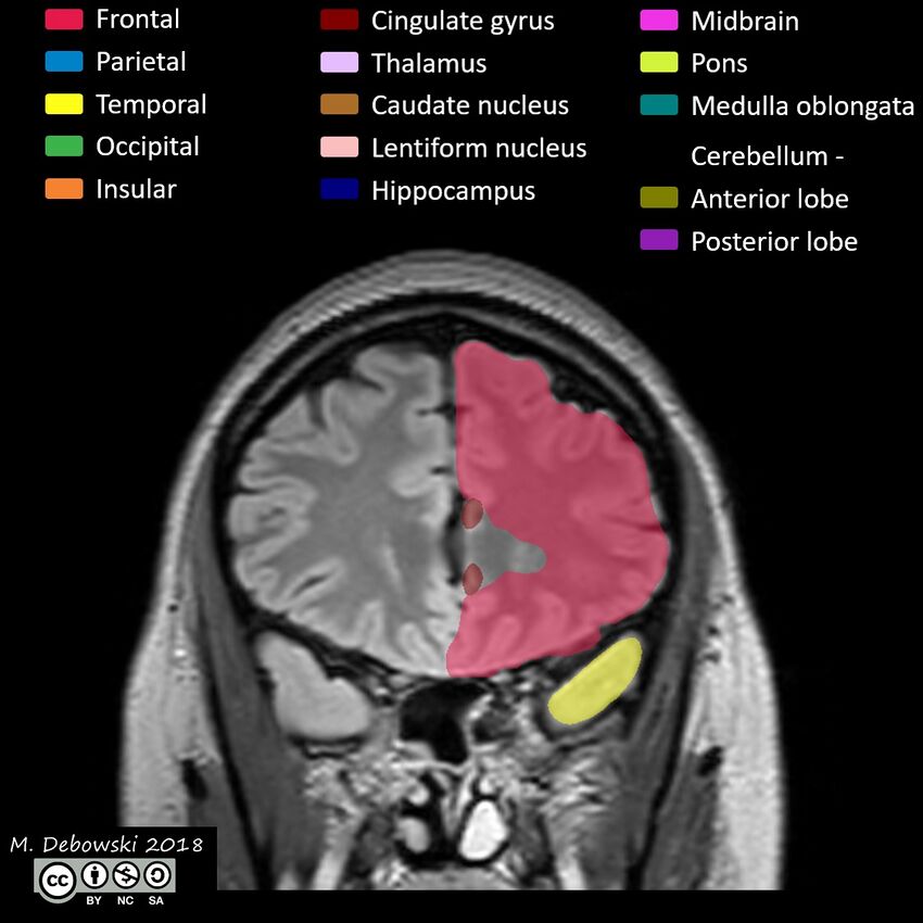 Brain lobes - annotated MRI (Radiopaedia 61691-69700 Coronal 18).JPG