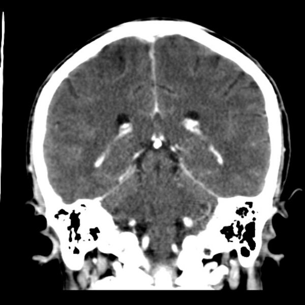 File:Brain metastases from lung cancer (Radiopaedia 24480-24781 Coronal C+ delayed 40).jpg