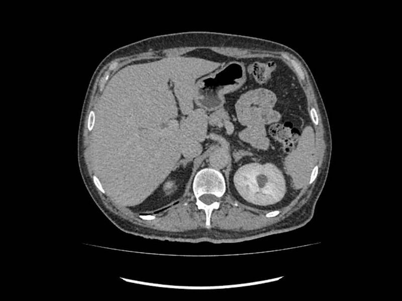File:Brain metastases from renal cell carcinoma (Radiopaedia 42222-45328 Axial C+ delayed 29).jpg
