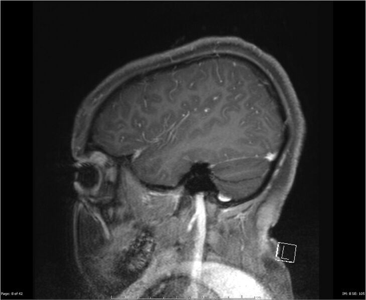 File:Brainstem glioma (Radiopaedia 21819-21775 D 8).jpg