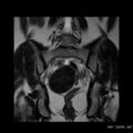 Broad ligament fibroid (Radiopaedia 49135-54241 Coronal T2 18).jpg