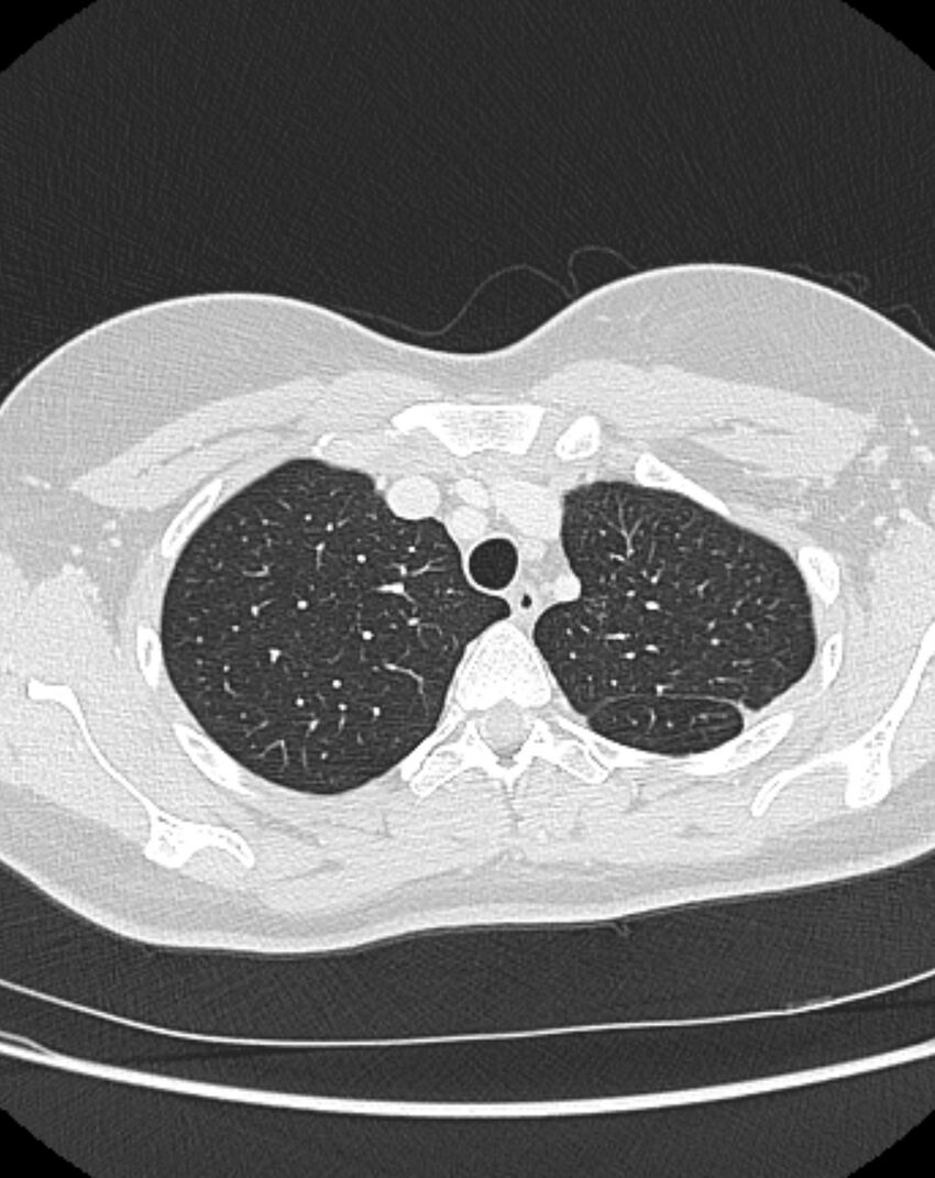 Bronchial atresia (Radiopaedia 50007-55297 Axial lung window 17).jpg