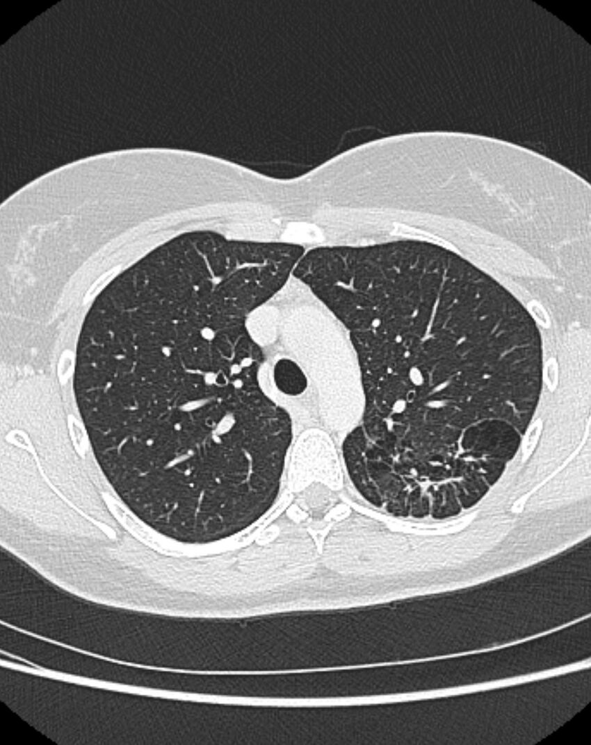 Bronchial atresia (Radiopaedia 50007-55297 Axial lung window 32).jpg