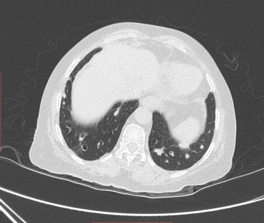 Bronchiectasis (Radiopaedia 72693-83293 Axial lung window 115).jpg