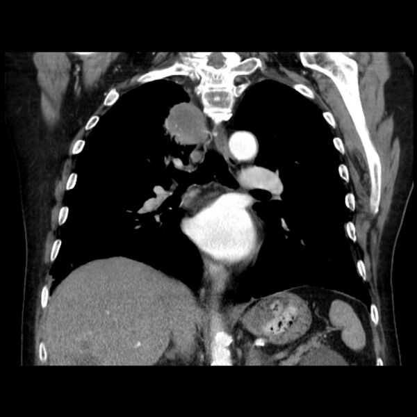 File:Bronchogenic adenocarcinoma and pulmonary embolism (Radiopaedia 9097-9806 C 29).jpg