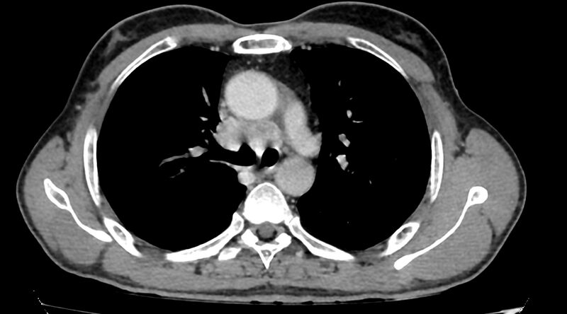 File:Bronchogenic carcinoma with superior vena cava syndrome (Radiopaedia 36497-38054 Axial C+ delayed 36).jpg